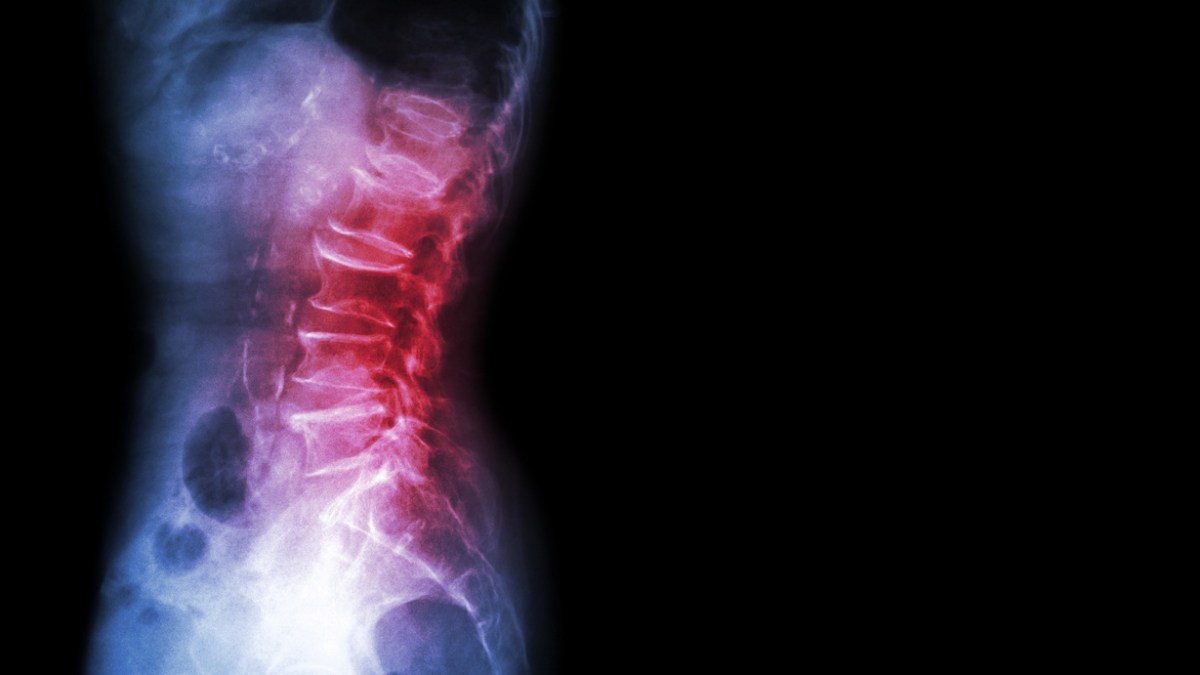 chronic back pain