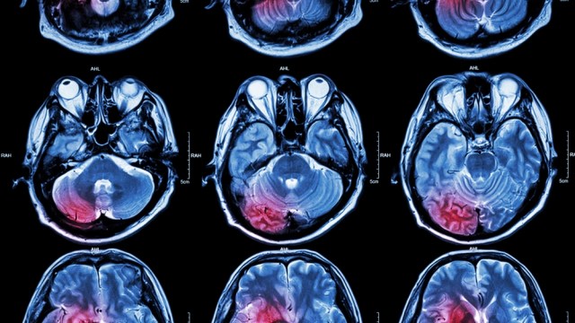 post-stroke dementia