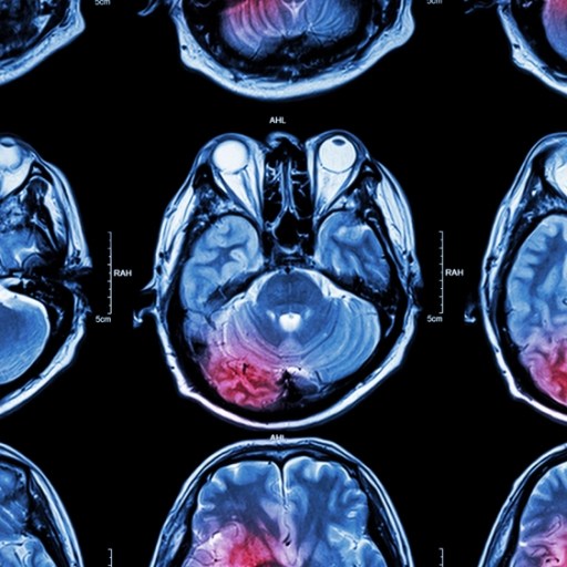 post-stroke dementia