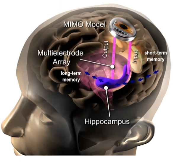 brain zapping