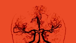 Black cerebral blood vessels are shown against a red background, resembling a brain scan or angiogram image.