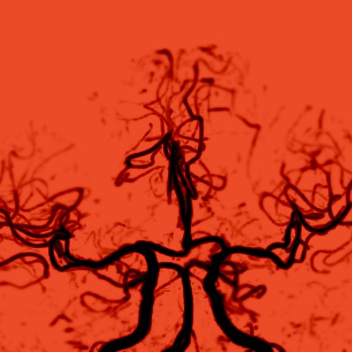 Black cerebral blood vessels are shown against a red background, resembling a brain scan or angiogram image.