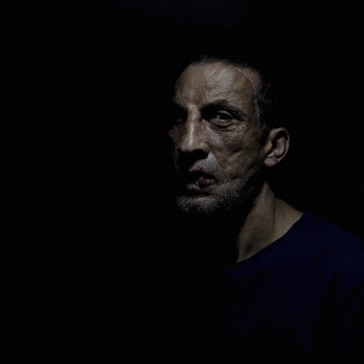 A man undergoing a face transplant glare at the camera in a dimly lit room.