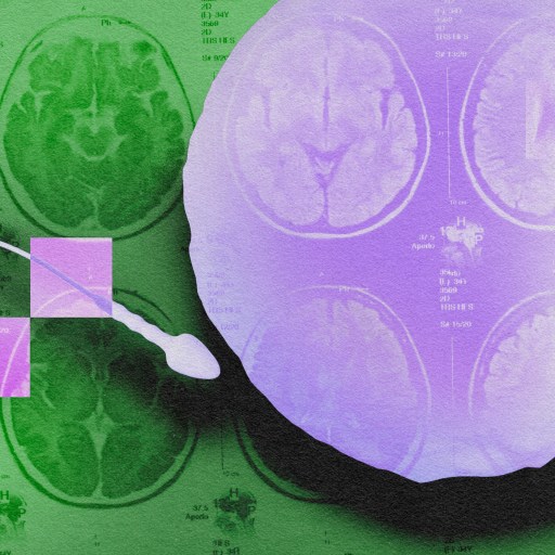 An image of an mri showing a brain.