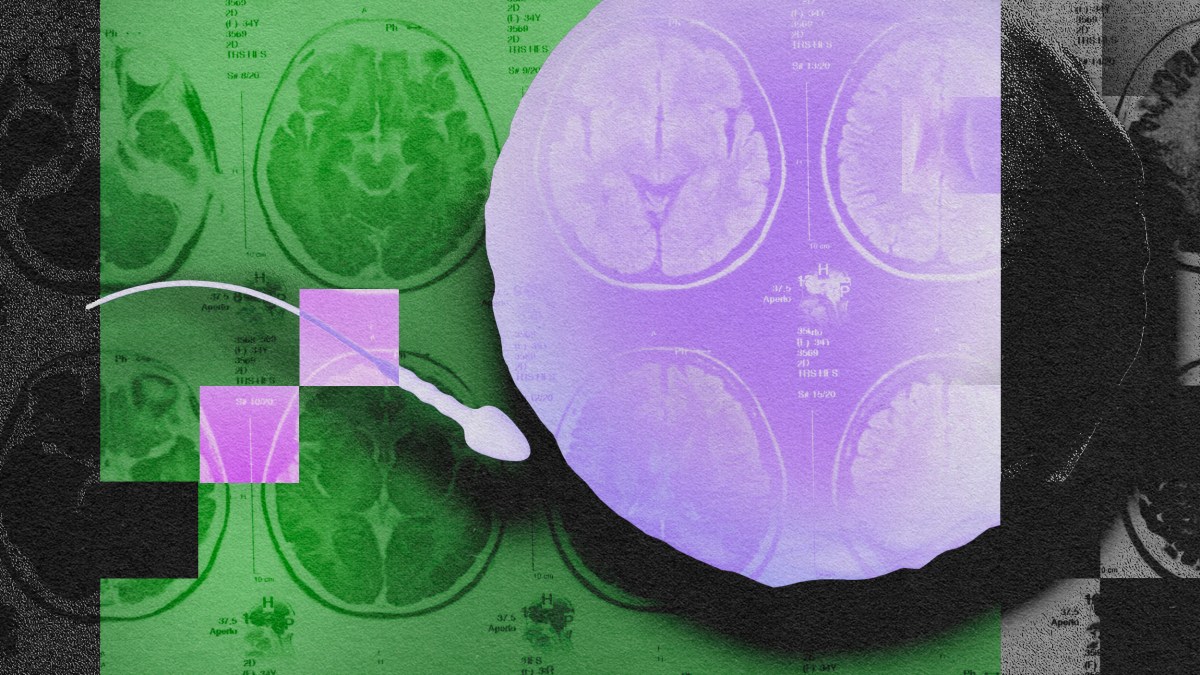 An image of an mri showing a brain.