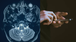 A split image showing a brain scan on the left and hands using a smartphone on the right.