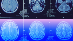 Six brain MRI scan images are arranged in two rows, showing various cross-sectional views of the human brain, with the bottom row featuring a blue and pink color overlay.