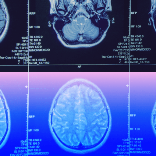 Six brain MRI scan images are arranged in two rows, showing various cross-sectional views of the human brain, with the bottom row featuring a blue and pink color overlay.